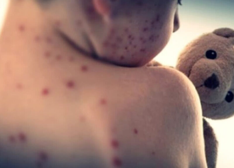 Measles outbreak in Bangladesh