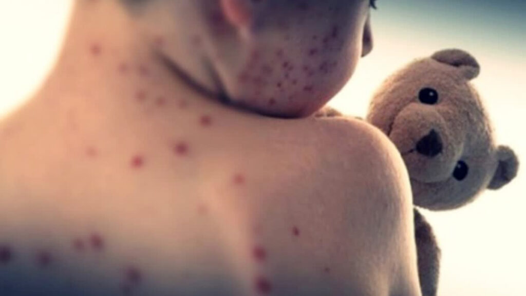 Measles outbreak in Bangladesh