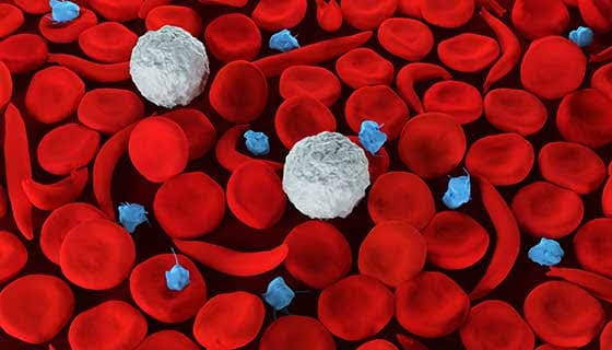 sickle cell