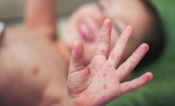 Measles Havoc in America